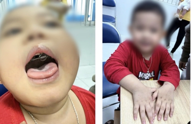 Ngưng thở khi ngủ, bé trai 4 tuổi tím tái cả khi thức - Ảnh 1.