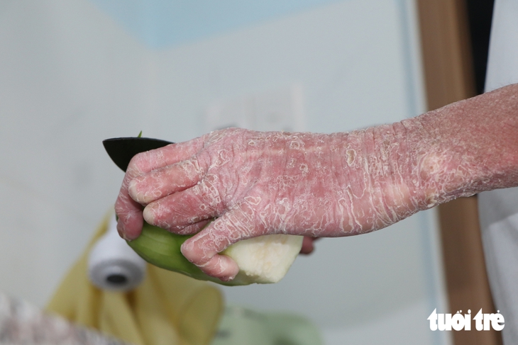 24 tuổi đời tràn ngập nỗi đau, nam sinh 'người rắn' dũng cảm bước vào đại học - Ảnh 12.