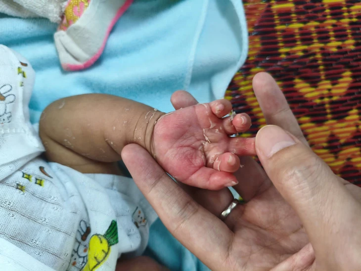 Trẻ 2 tháng tuổi mắc giang mai bẩm sinh, dễ nhầm bệnh ngoài da nhưng nguy hiểm - Ảnh 1.