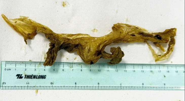 Hy hữu: Đau bụng, nội soi phát hiện trong ruột non có túi ni lông dài 20cm - Ảnh 1.