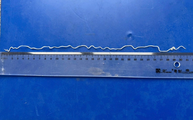 Phát hiện con đỉa nằm trong khoang mũi suốt 1 tháng - Ảnh 2.