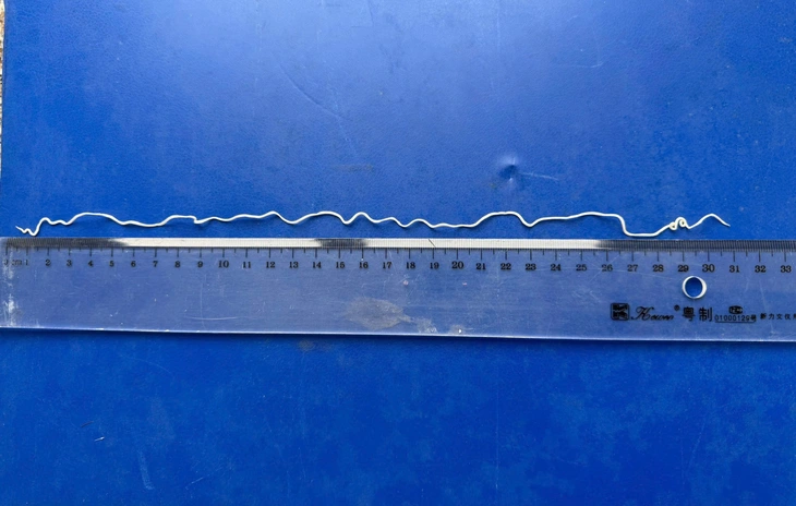 Tự nặn mụn trên cánh tay, phát hiện con giun rồng dài 20cm dưới da - Ảnh 2.