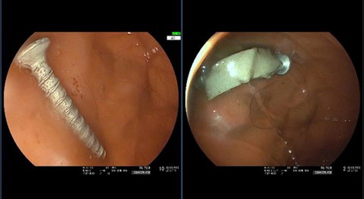 Cứu sống bé gái 11 tháng tuổi nuốt đinh vít dài 4cm và nhiêu dị vật khác vào dạ dày - Ảnh 1.