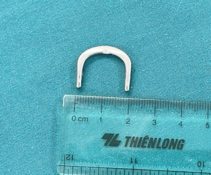 Bé gái 3 tuổi nuốt móc khóa dây đồng hồ, không chủ quan với những vật nhỏ quanh trẻ - Ảnh 1.