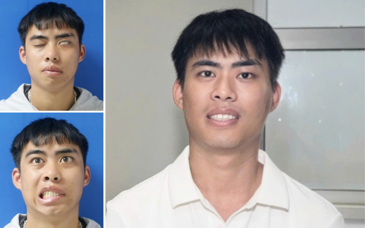 Phục hồi thành công gương mặt cho nam thanh niên liệt mặt suốt 7 năm - Ảnh 2.