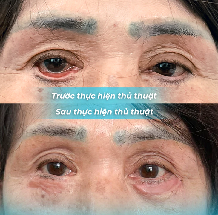 Phẫu thuật mí mắt bị lật nặng hai mi dưới, quay lại thì cơ sở làm đẹp đã đóng cửa - Ảnh 1.