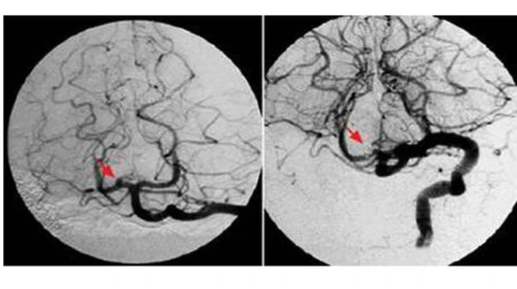 Chóng mặt, mờ mắt thoáng qua rồi tự khỏi: Có thể là dấu hiệu của đột quỵ - Ảnh 2.