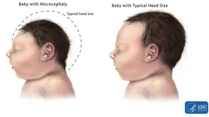 Trẻ bị chứng não nhỏ theo mô tả của Trung tâm Kiểm soát và phòng chống dịch bệnh Mỹ (CDC)