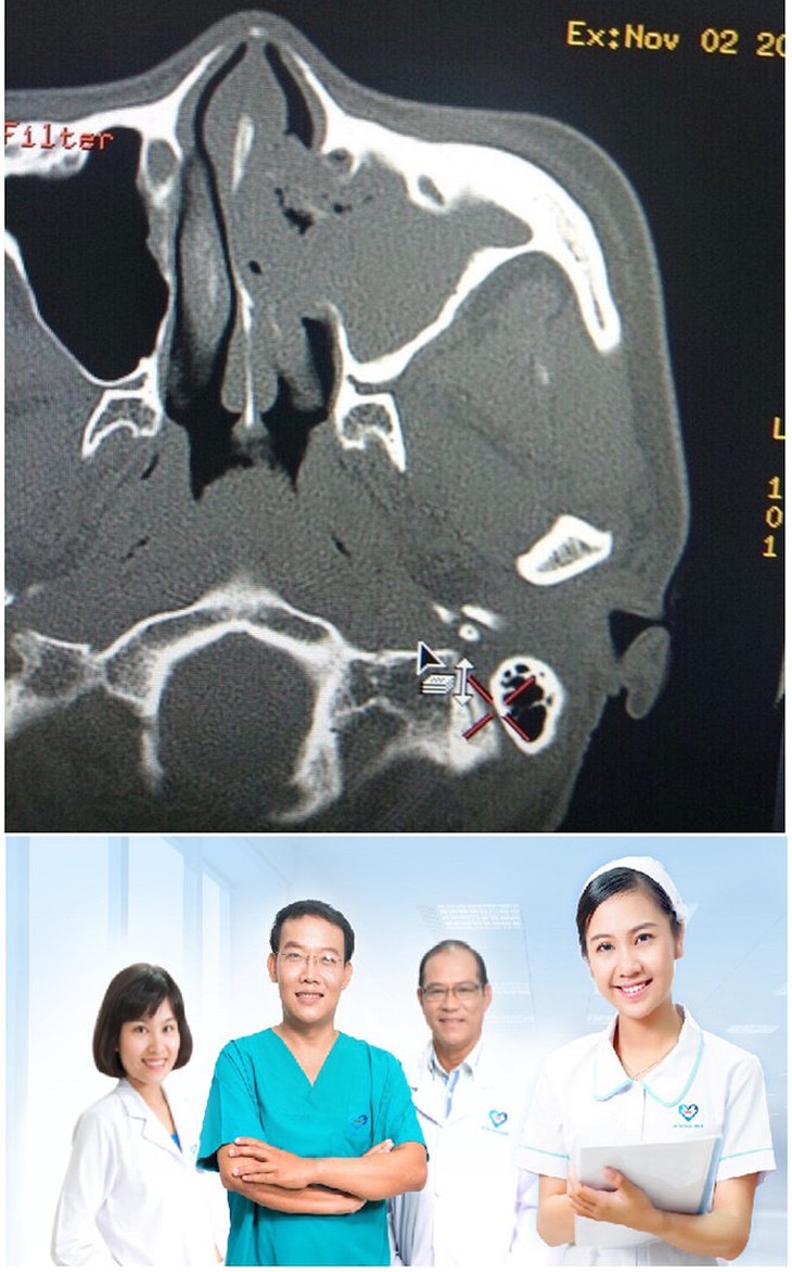 Phát hiện sớm ca U sàng hàm do nấm aspergillosis