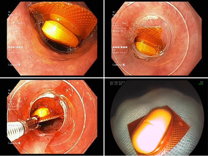 ​Bi hài những ca nội soi lấy dị vật ở người lớn