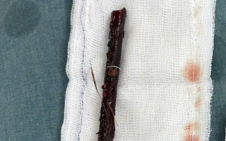 Vietnamese doctors remove 16cm tree branch lodged in 3-year-old girl's abdomen for over 4 months