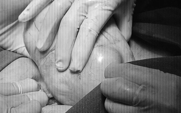 Vietnamese doctors successfully remove nearly 2kg ovarian cyst