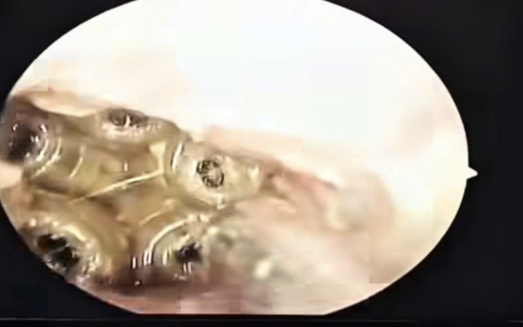 Doctors remove 5 live maggots from woman’s ear in south-central Vietnam