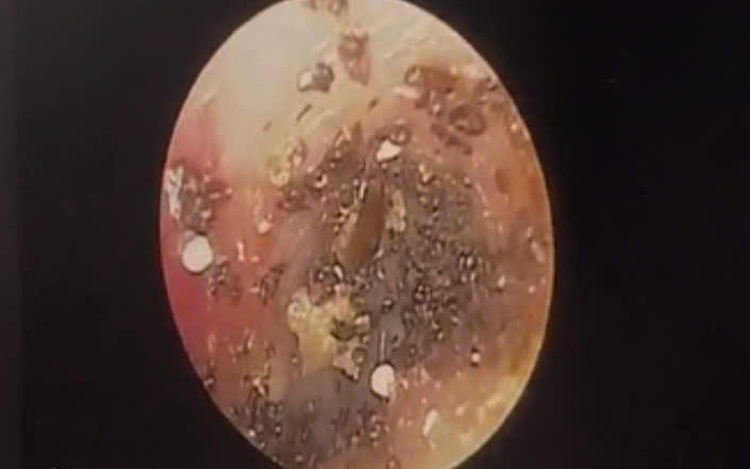 Dog ticks found in ear of 9-year-old girl in southern Vietnam