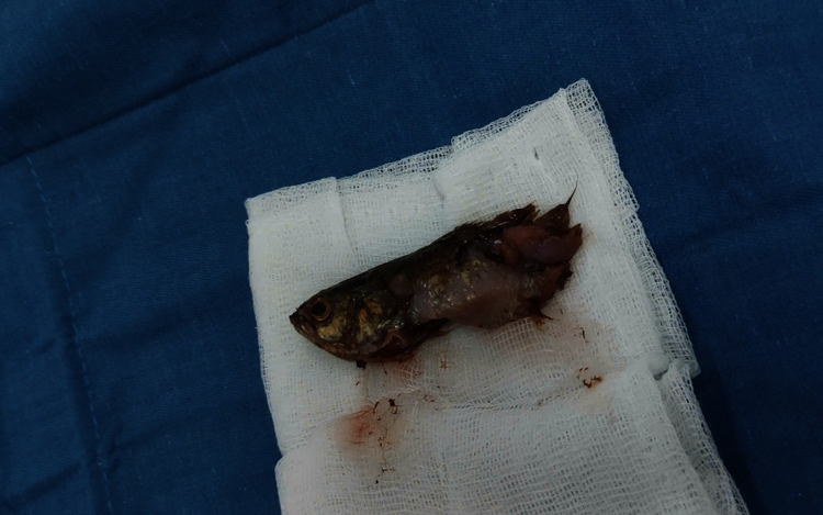 Vietnamese doctors remove live fish from child’s throat