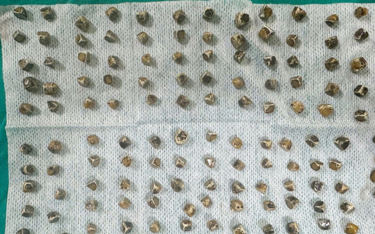 Doctors find 130 gallstones in Vietnamese woman’s gallbladder
