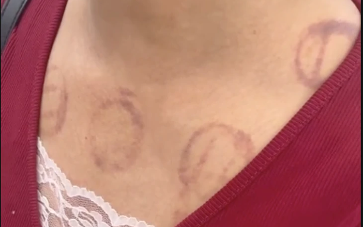 Social media trend of pricking, wet cupping to prevent strokes raises concern in Vietnam