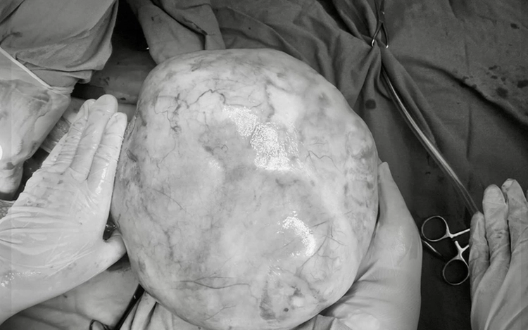 Vietnamese teen girl undergoes surgery to remove 4.3kg ovarian tumor with teeth, hair, bone