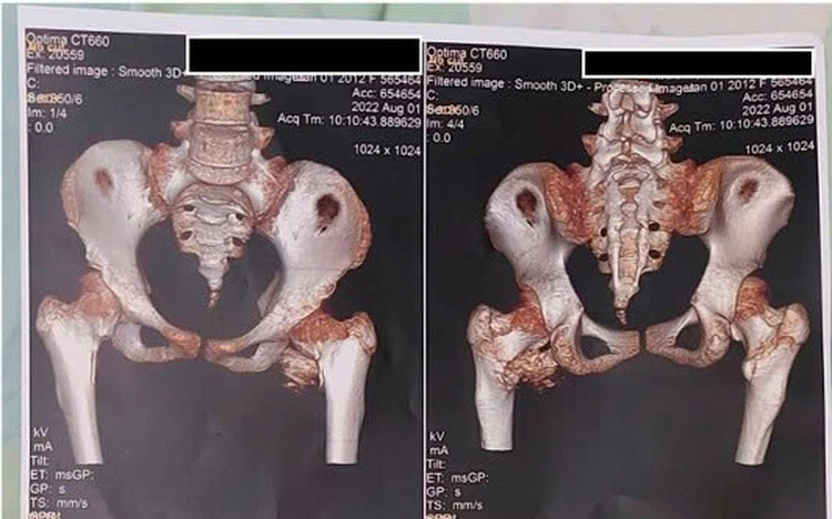Rare stone man syndrome diagnosed in 12-year-old girl in Ho Chi Minh City