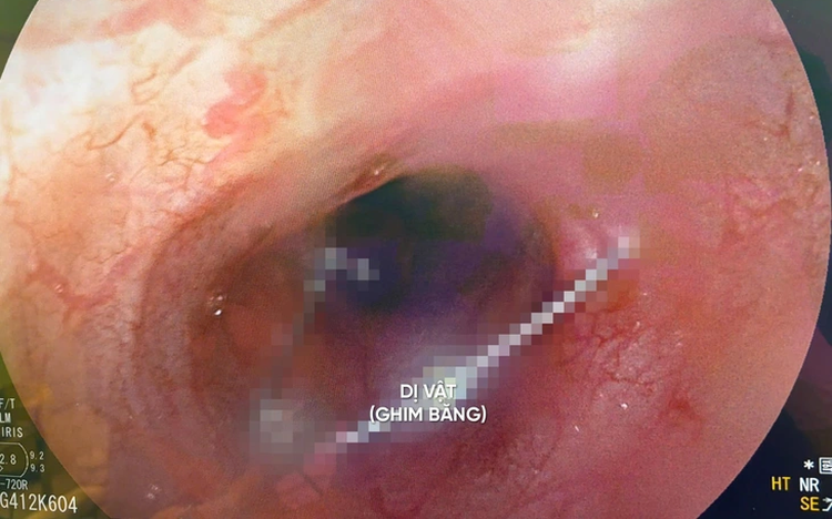 Vietnamese doctors remove open safety pin from Kazakh baby’s esophagus