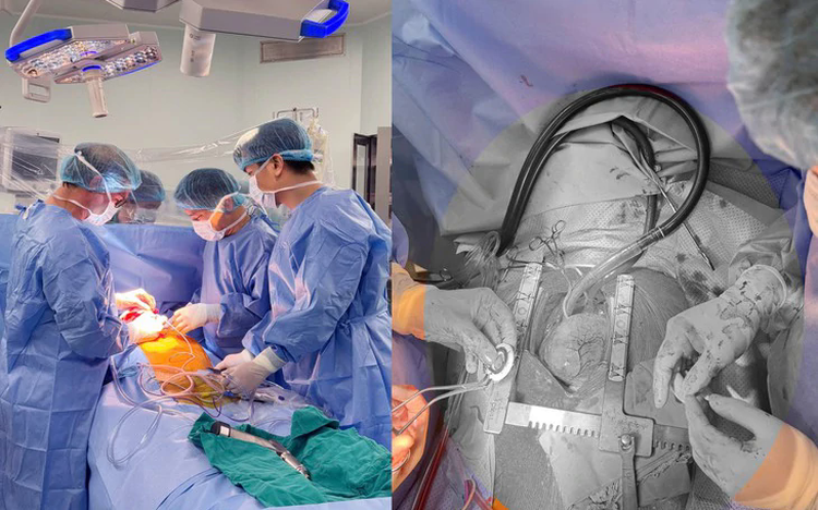 Vietnam performs 1st successful implantation of compact mechanical heart pump