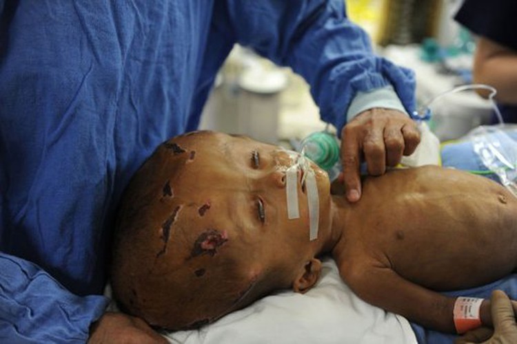 Indian medics reconstruct baby's swollen head