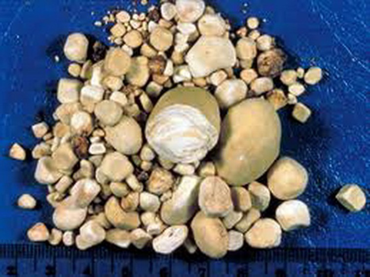 Substance that causes kidney stones found in food samples