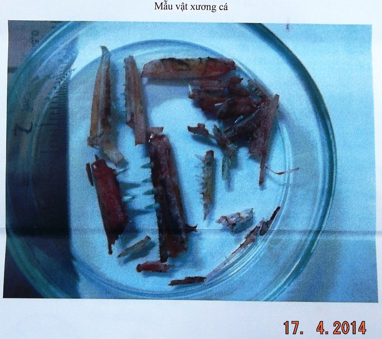Russian victim of needlefish wants to keep its teeth as Vietnam trip memento