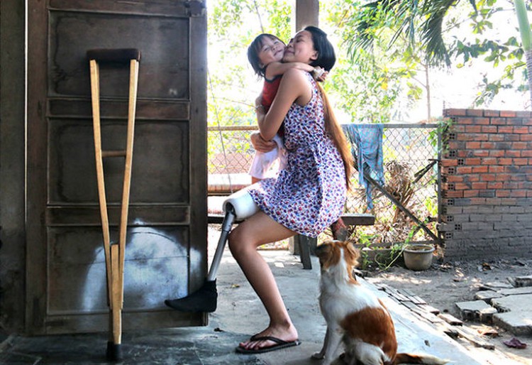 Prostheses bring hope to poor Vietnamese (photos)