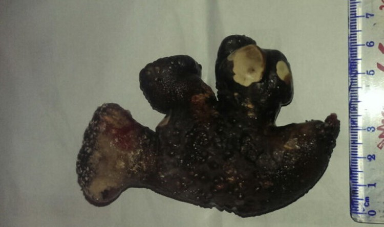 420g coral-like stone removed from Vietnamese man’s kidneys