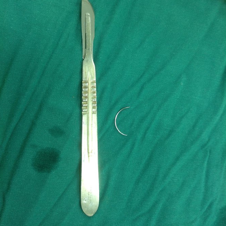 Vietnam man lives 15 years with surgical suture in stomach