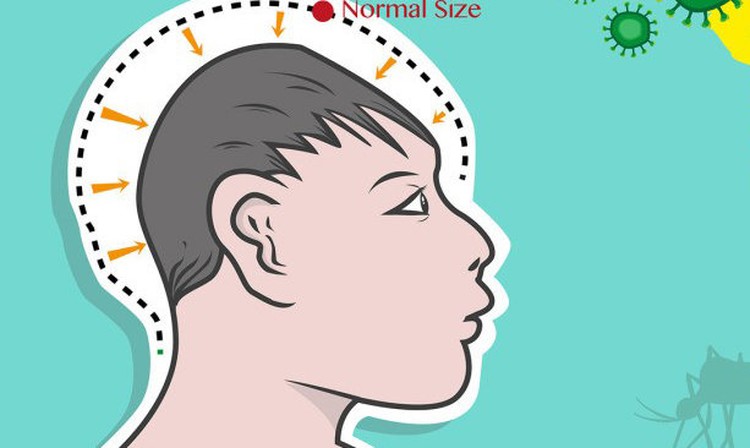 Vietnam reports first microcephaly case likely linked to Zika: gov't agency