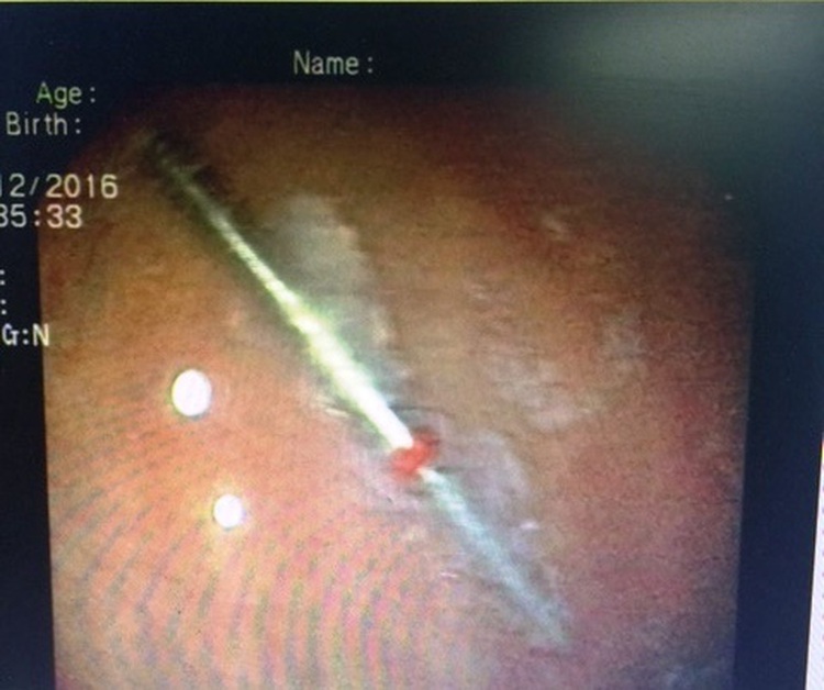 Ho Chi Minh City dentist drops burr down patient’s throat