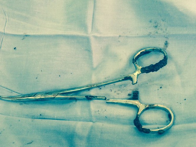 Vietnamese doctors remove pair of scissors colleagues left in patient for 18 years