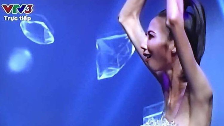 Super-thin model triggers health debate in Vietnam