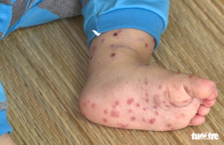 Two children die of dengue, HFMD in Vietnam’s Mekong Delta province