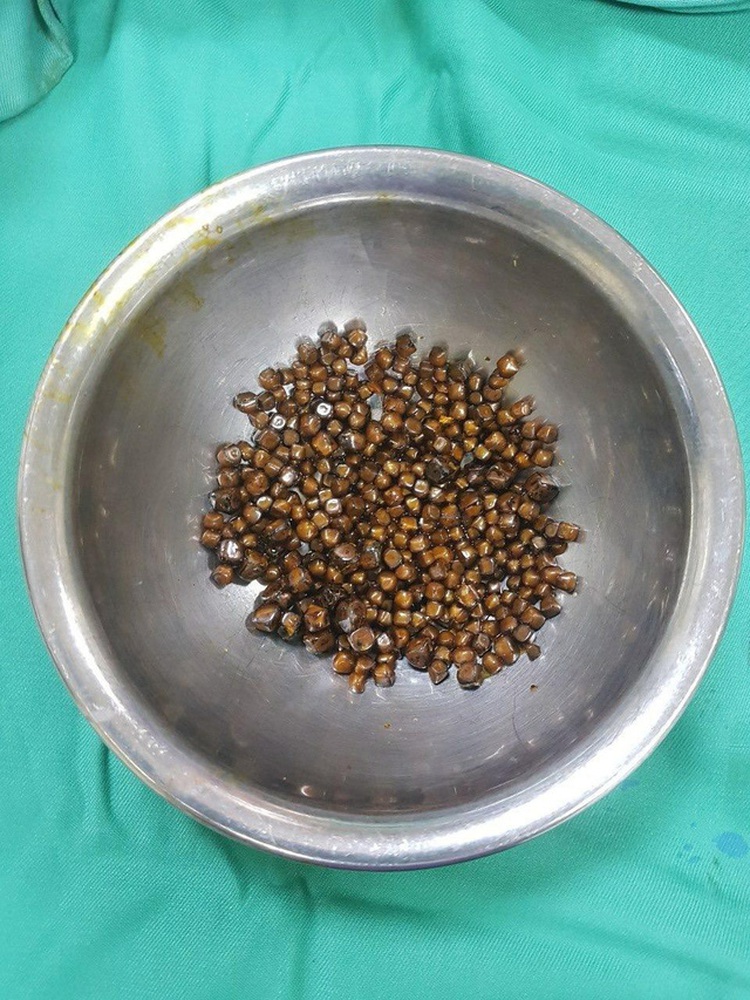 Doctors find 400 gallstones in Vietnamese woman’s gallbladder