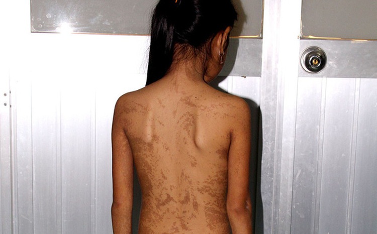 Vietnam doctors successfully treat girl suffering two rare genetic diseases