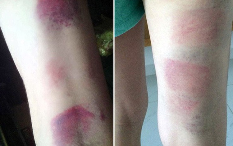 Vietnamese teacher suspended after beating 22 eighth-graders with ruler
