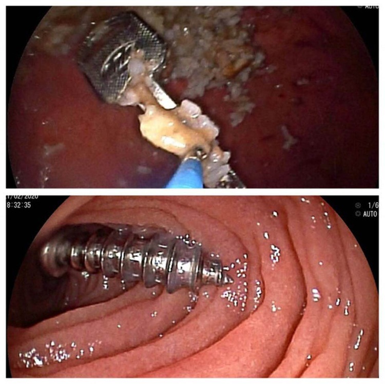Ho Chi Minh City hospital saves two children who swallowed key, screw