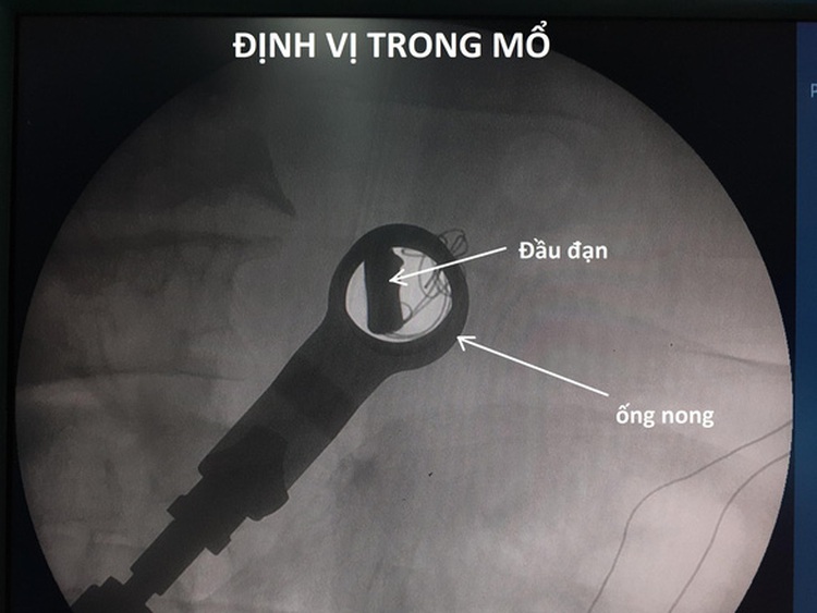 Vietnam man has bullet fragment removed from body after 50 years