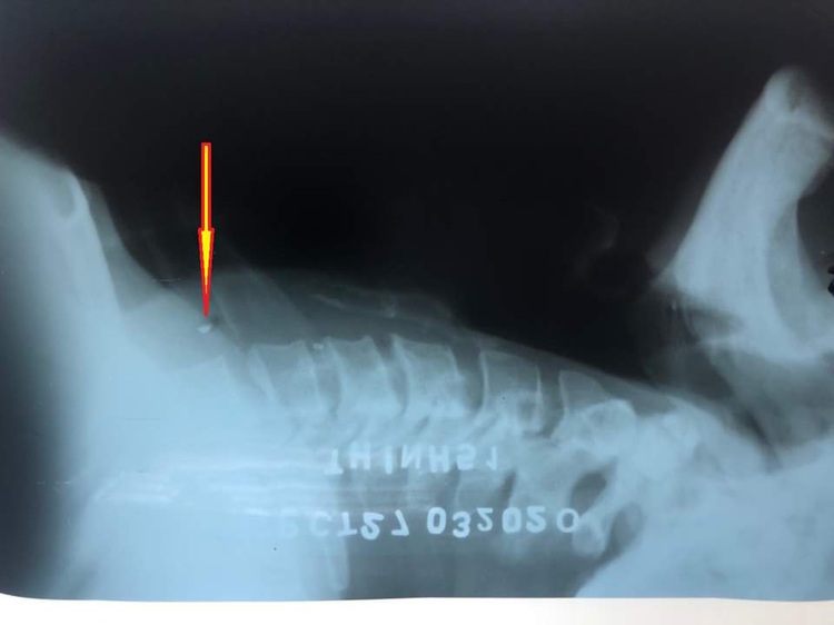 Vietnam man damages gullet after trying ‘home remedies’ to remove stuck fish bone