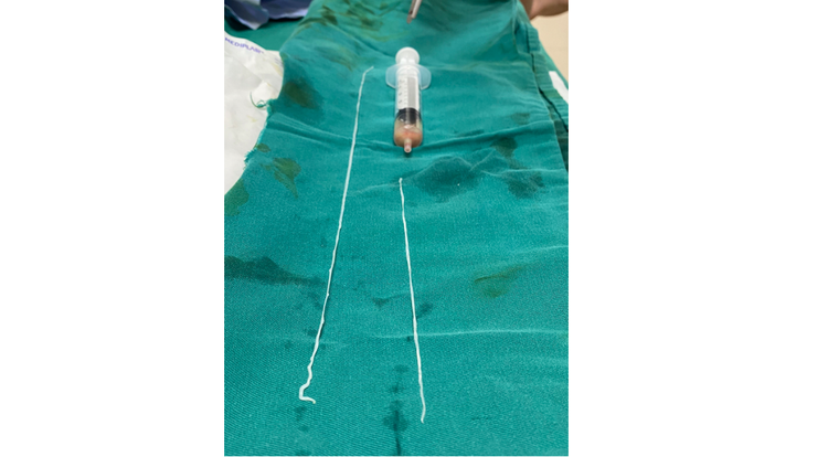 Vietnamese man infested with rare worms