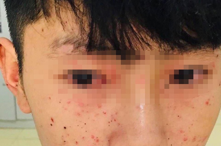Three Vietnamese students injured in laptop explosion