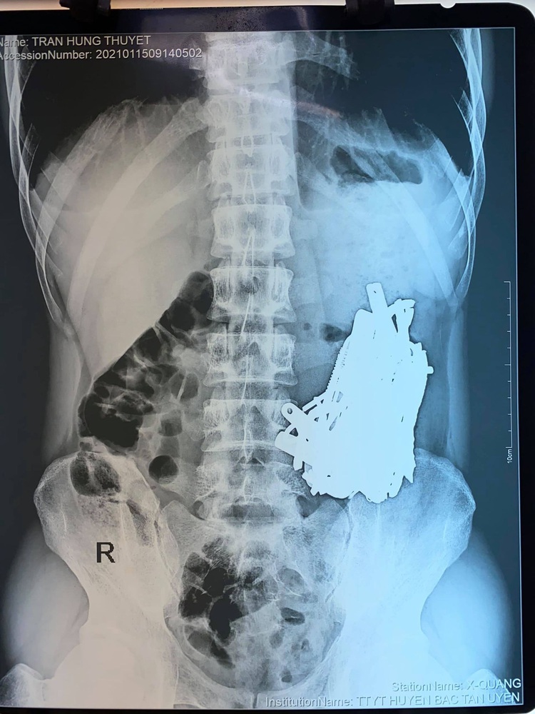 Vietnam doctors remove 1kg of metal objects from patient with pica disorder