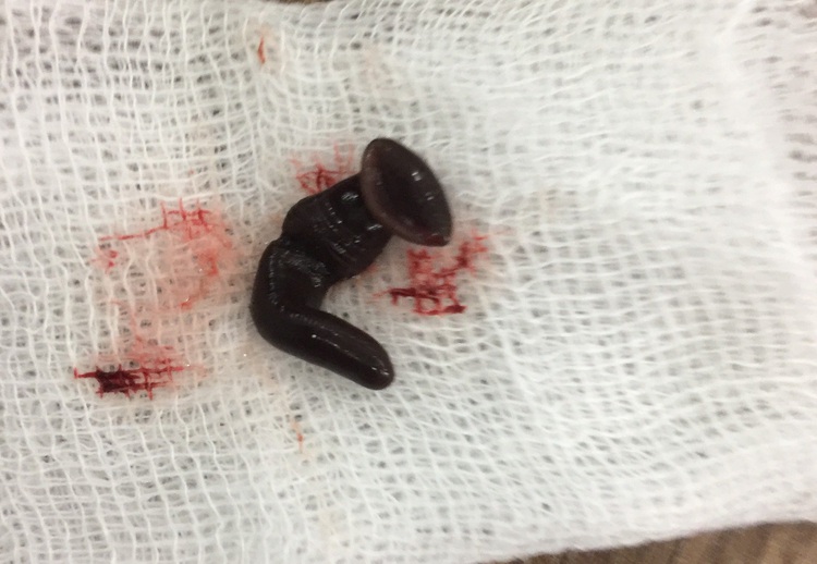 Doctors remove 4cm leech from patient’s nose in central Vietnam
