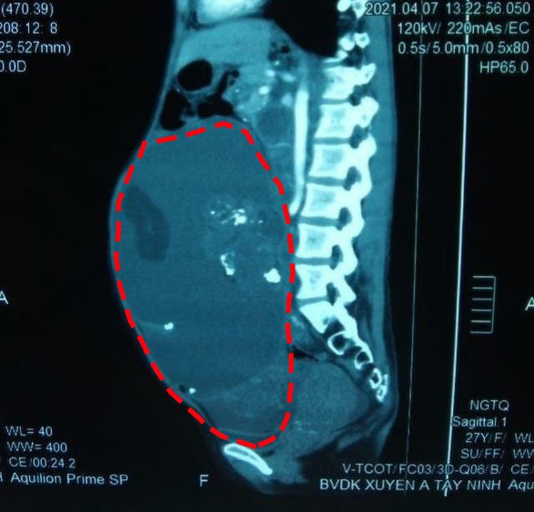 Doctors remove 8kg ovarian tumor from 27-year-old woman in Vietnam