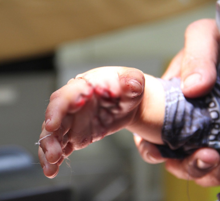 Toddler suffers multiple hand bites by homegrown crocodile in Vietnam