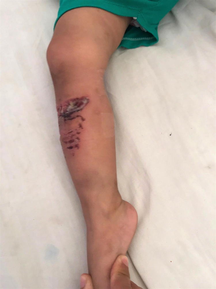 Child hospitalized after being mauled by neighbor’s pit bull in Vietnam
