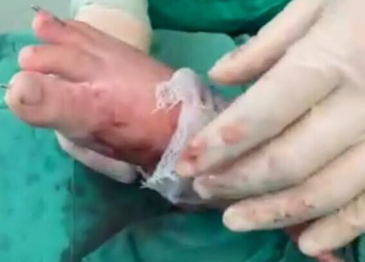 Ho Chi Minh City hospital reconstructs boy’s severed foot after five replantation sessions